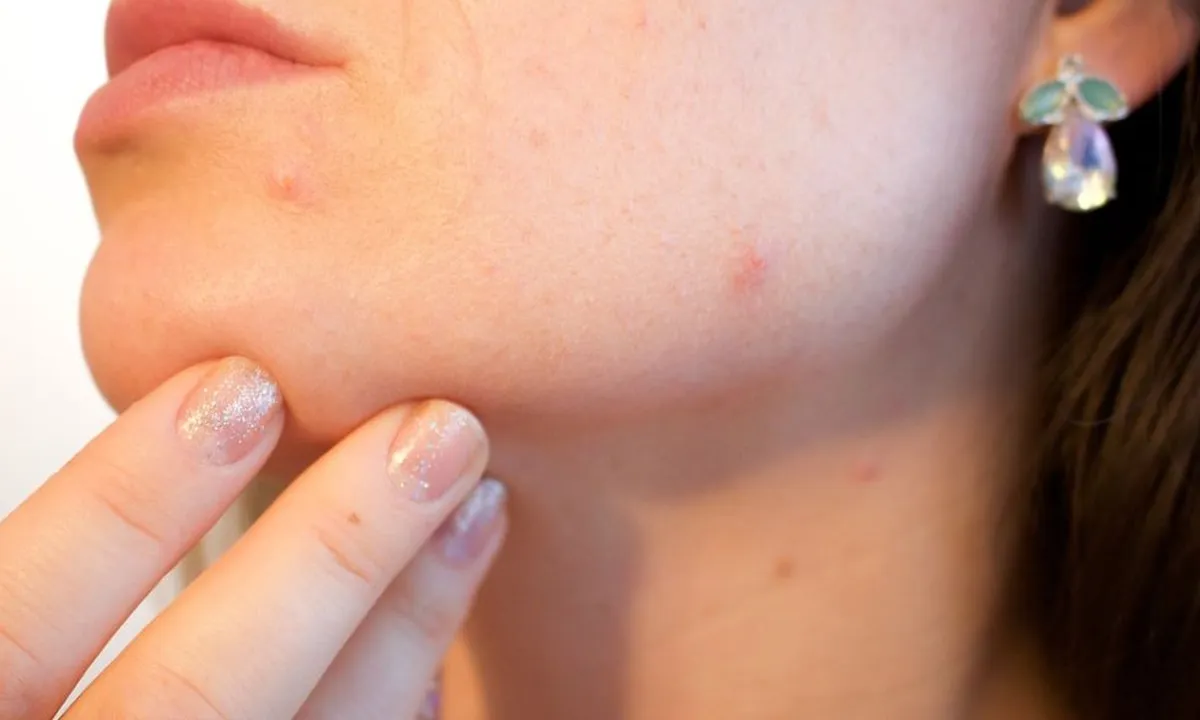 Cara Ampuh Menghilangkan Bekas Jerawat agar Makin Percaya Diri, Tanpa Efek Samping