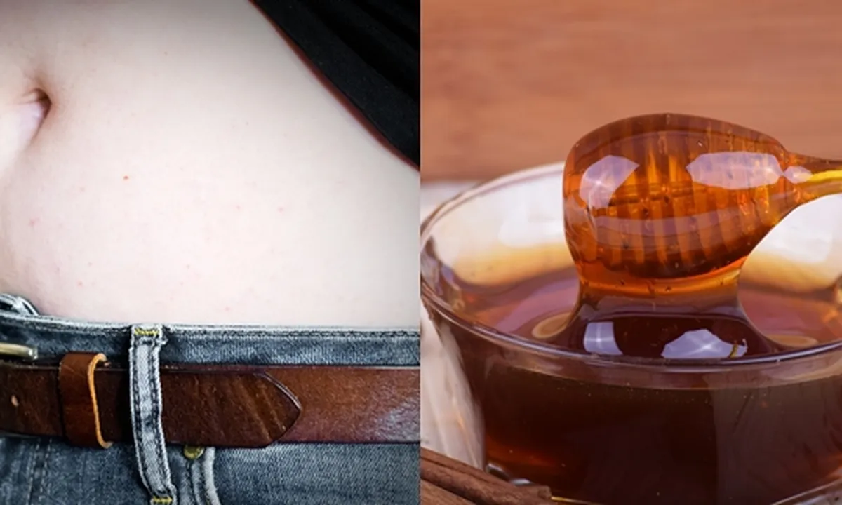 Cara Menghilangkan Stretch Mark Secara Alami dan Juga Praktis