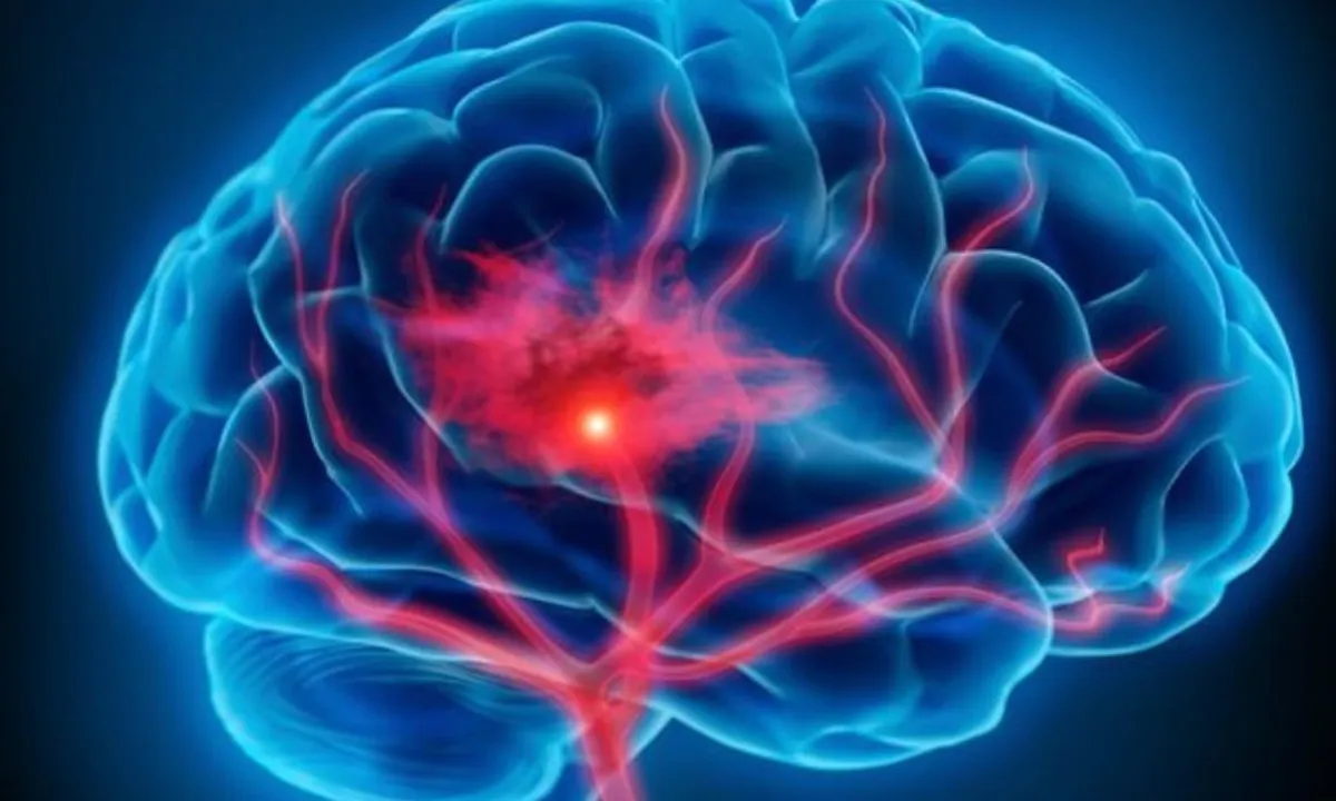 Cegah Stroke dan Tingkatkan Kesehatan Anda dengan Langkah Sederhana
