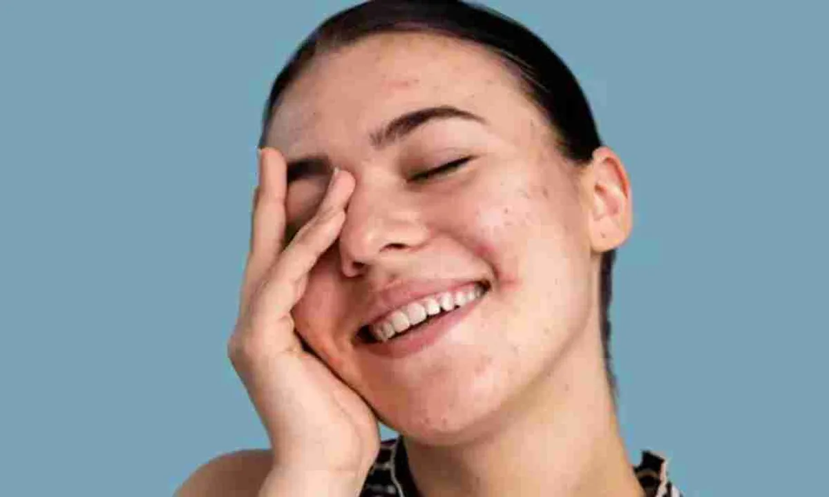 Jerawat Hilang Tanpa Skincare? Ini 9 Cara Alami yang Bisa Dicoba