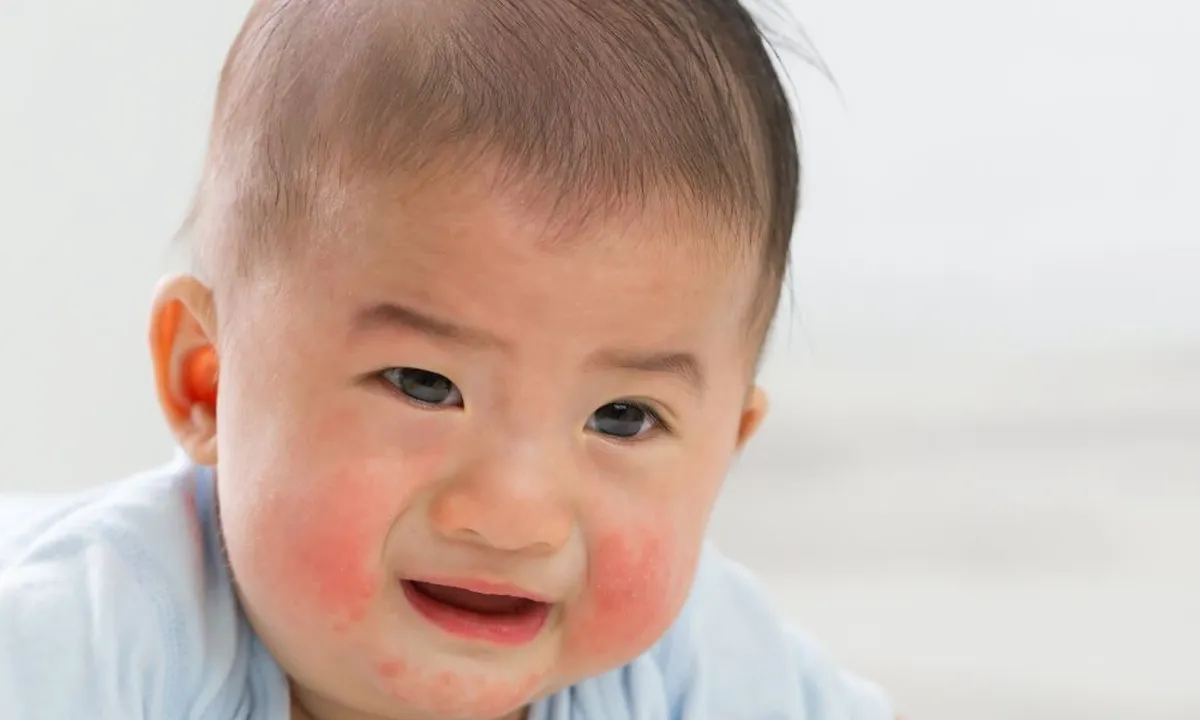 Mengenal Ciri Kuning pada Bayi: Gejala, Penyebab, dan Cara Penanganannya