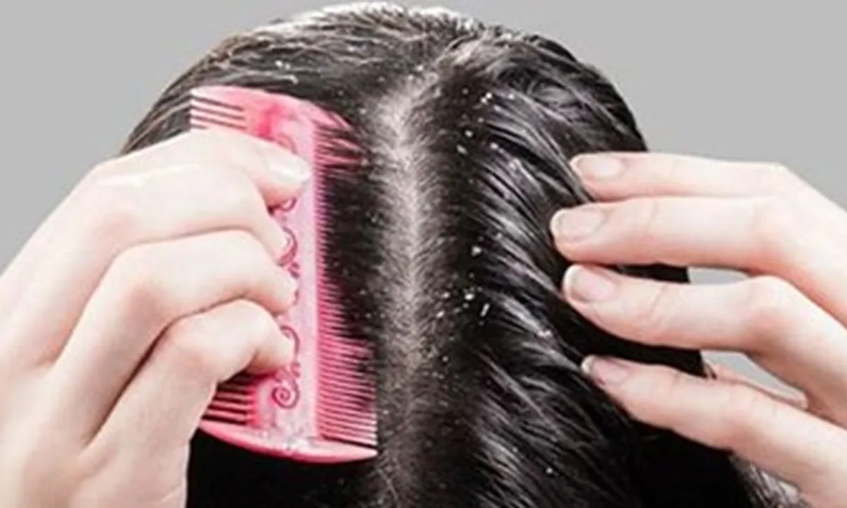 Perlu Diketahui Ini 5 Penyebab Ketombe, Salah Satunya Malas Menyisir Rambut