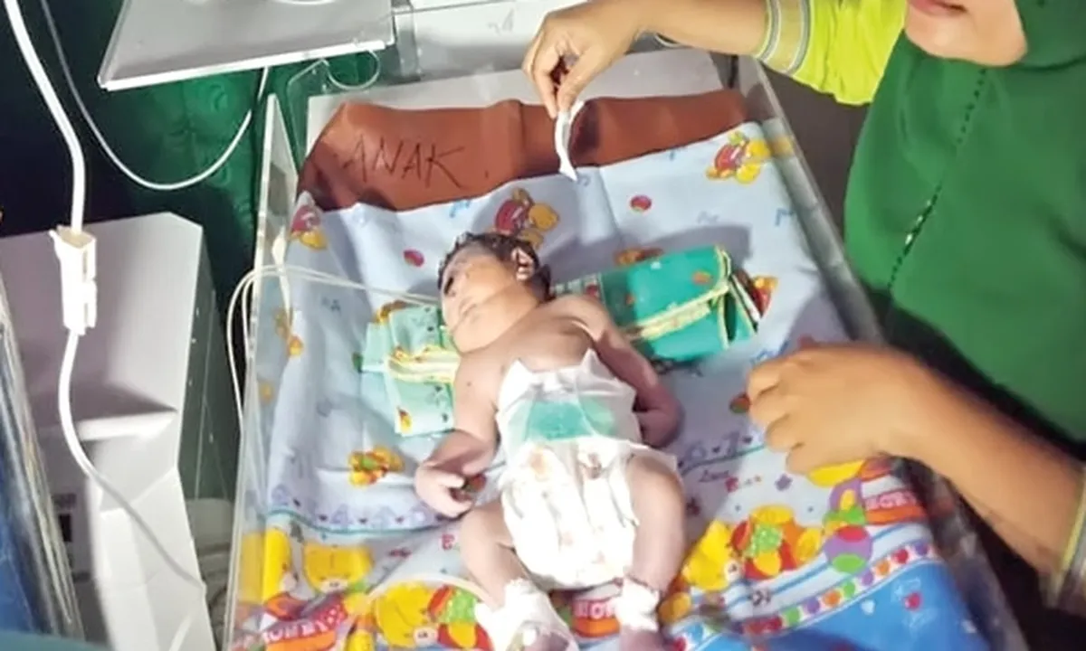 Tak Mampu Bertahan, Bayi Bermata Satu Meninggal Dunia Setelah Dirawat Selama 7 Jam