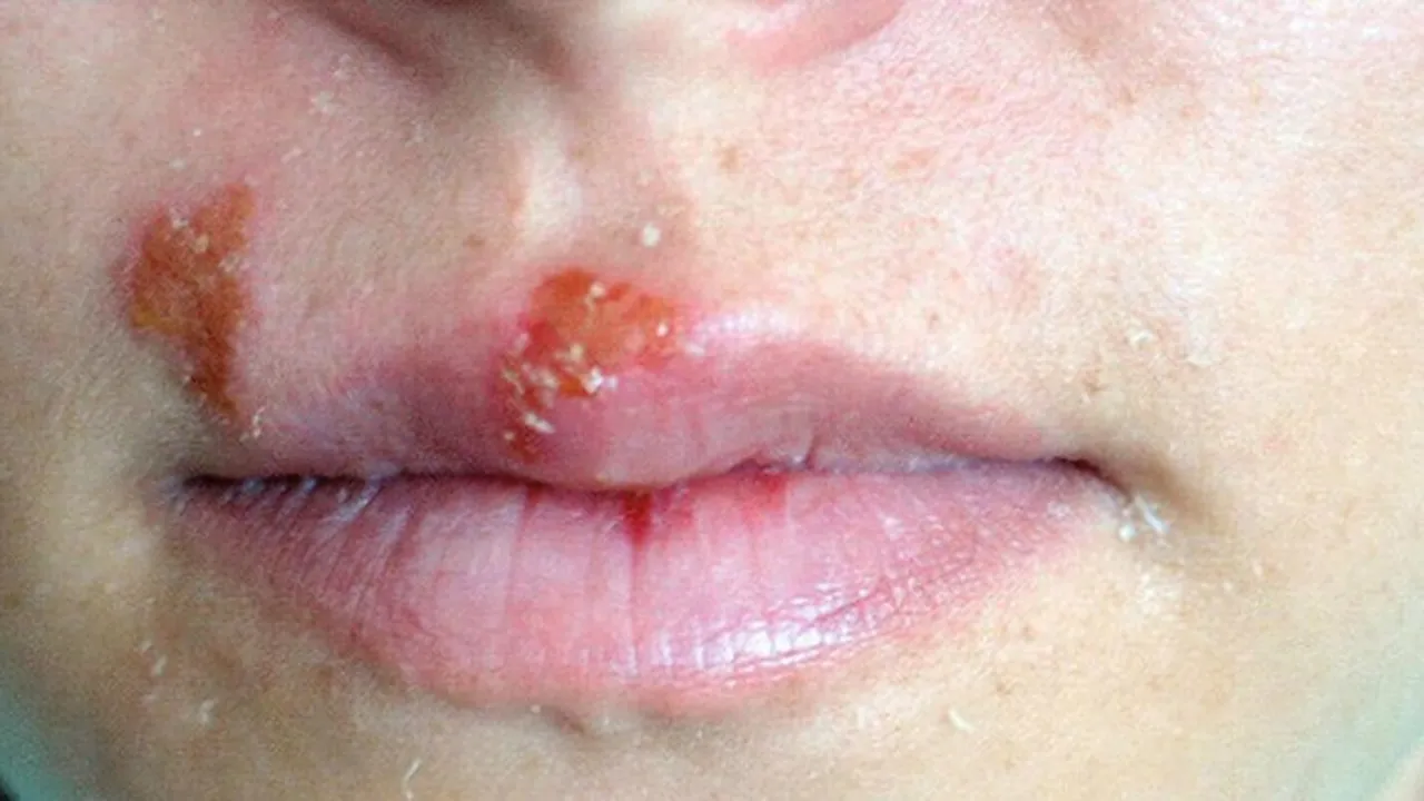 10 Cara Mengobati Herpes dengan Bahan Alami, Salah Satunya Menggunakan Tepung Jagung