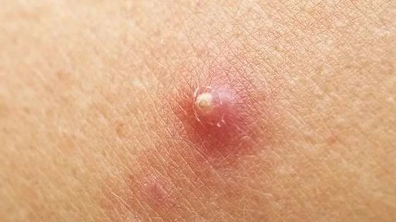 10 Penyebab Bisul dan Gejalanya, Rentan Terjadi Pada Lipatan Kulit