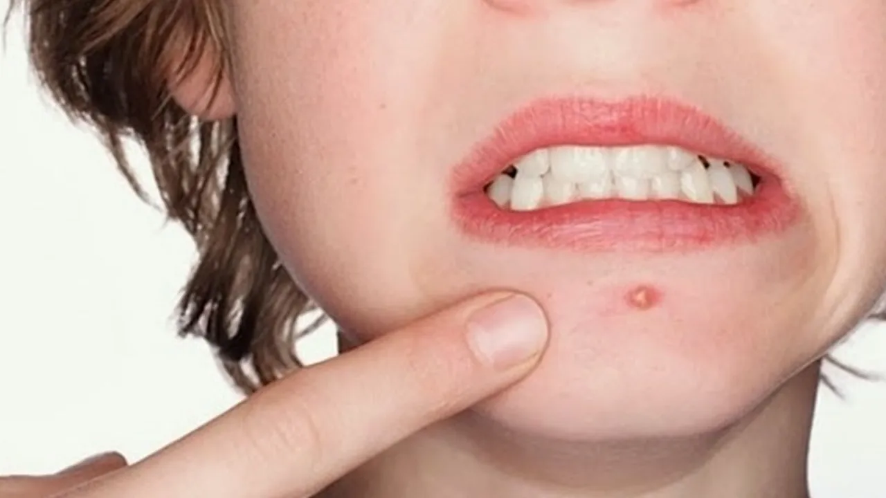 6 Arti Jerawat di Bawah Bibir Menurut Primbon Jawa, Tidak Selamanya Pertanda Buruk