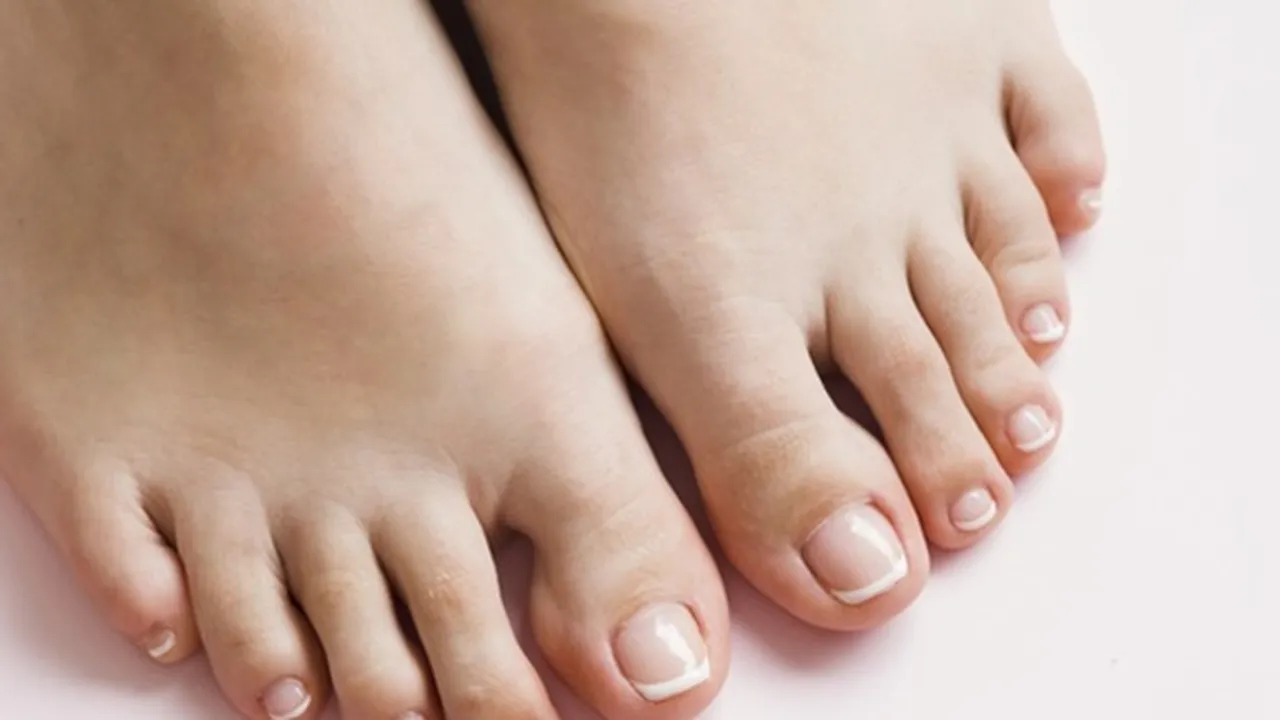 7 Cara Mengobati Kutu Air di Kaki Secara Alami, Salah Satunya dengan Bawang Putih.