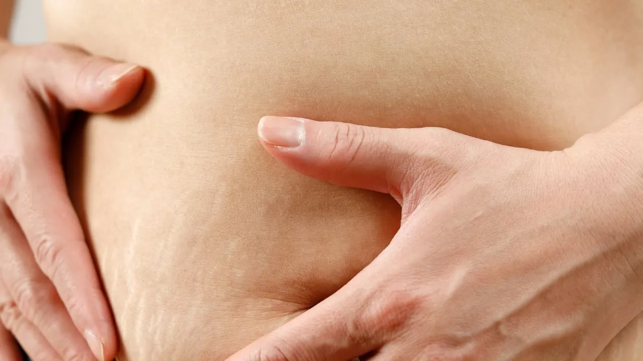 7 Metode Ampuh dan Praktis untuk Mengatasi Stretch Marks!