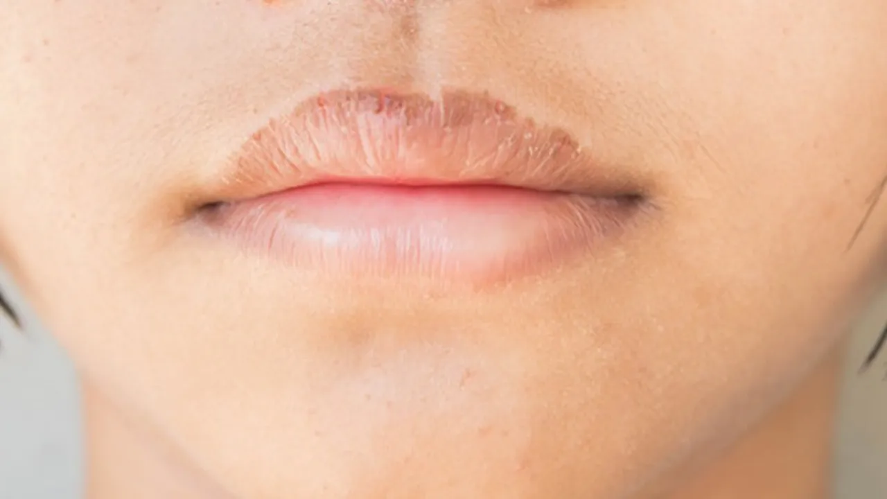 7 Penyebab Bibir Kering dan Pecah-Pecah, Hati-Hati Bisa Disebabkan Kebiasaan Sepele