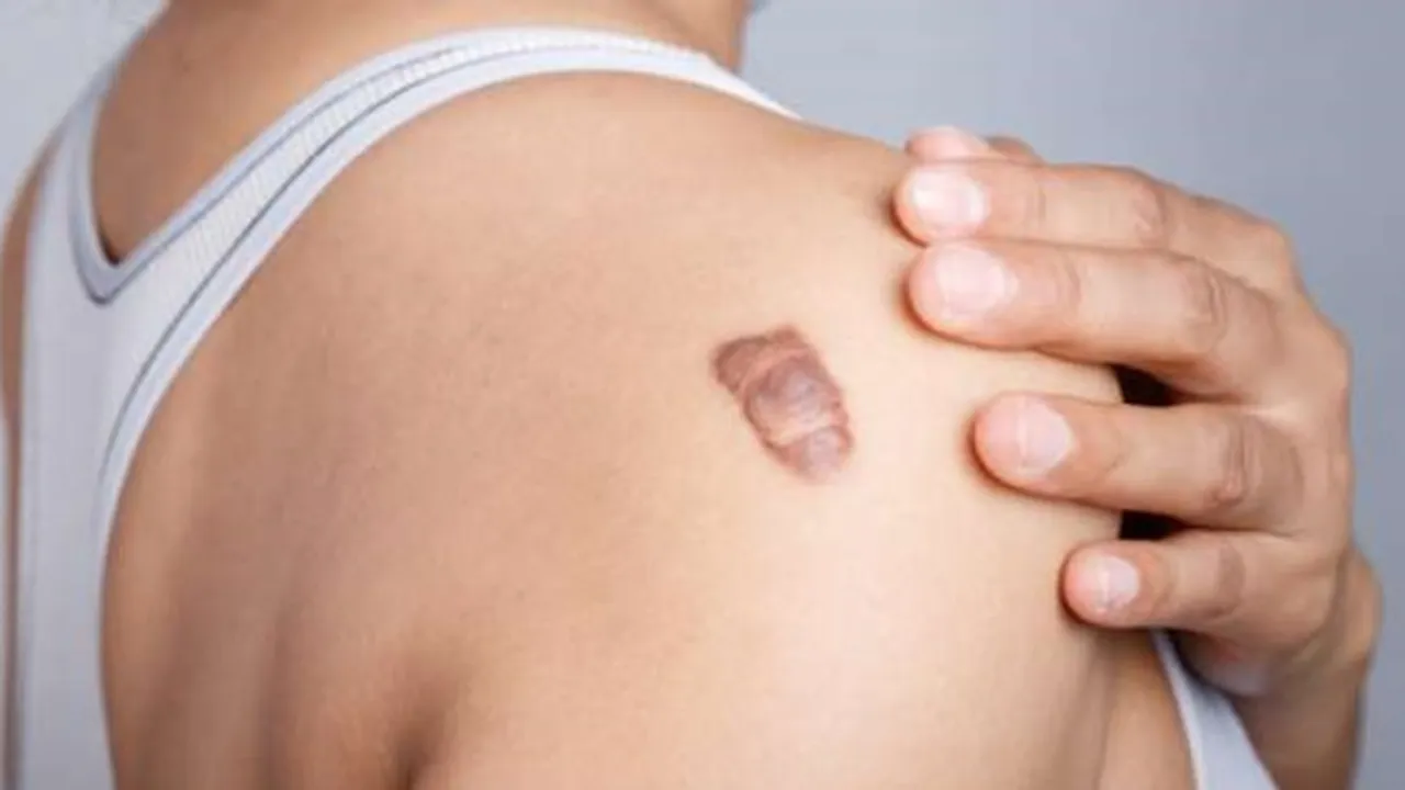 9 Cara Menghilangkan Keloid Secara Medis dan Alami, Pilih Mana?