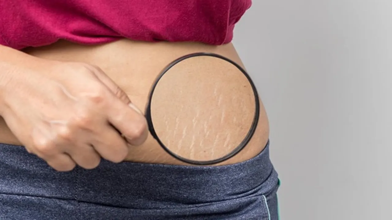 9 Penyebab Stretch Mark yang Umum di Tubuh dan Cara Mengatasinya