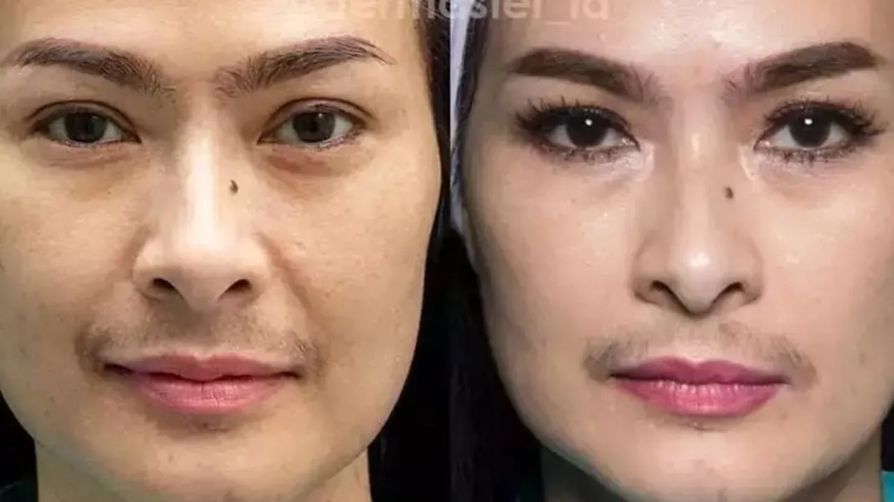 Bikin Pangling, Begini Potret Perbandingan Wajah 10 Seleb Sebelum dan Setelah Tanam Benang