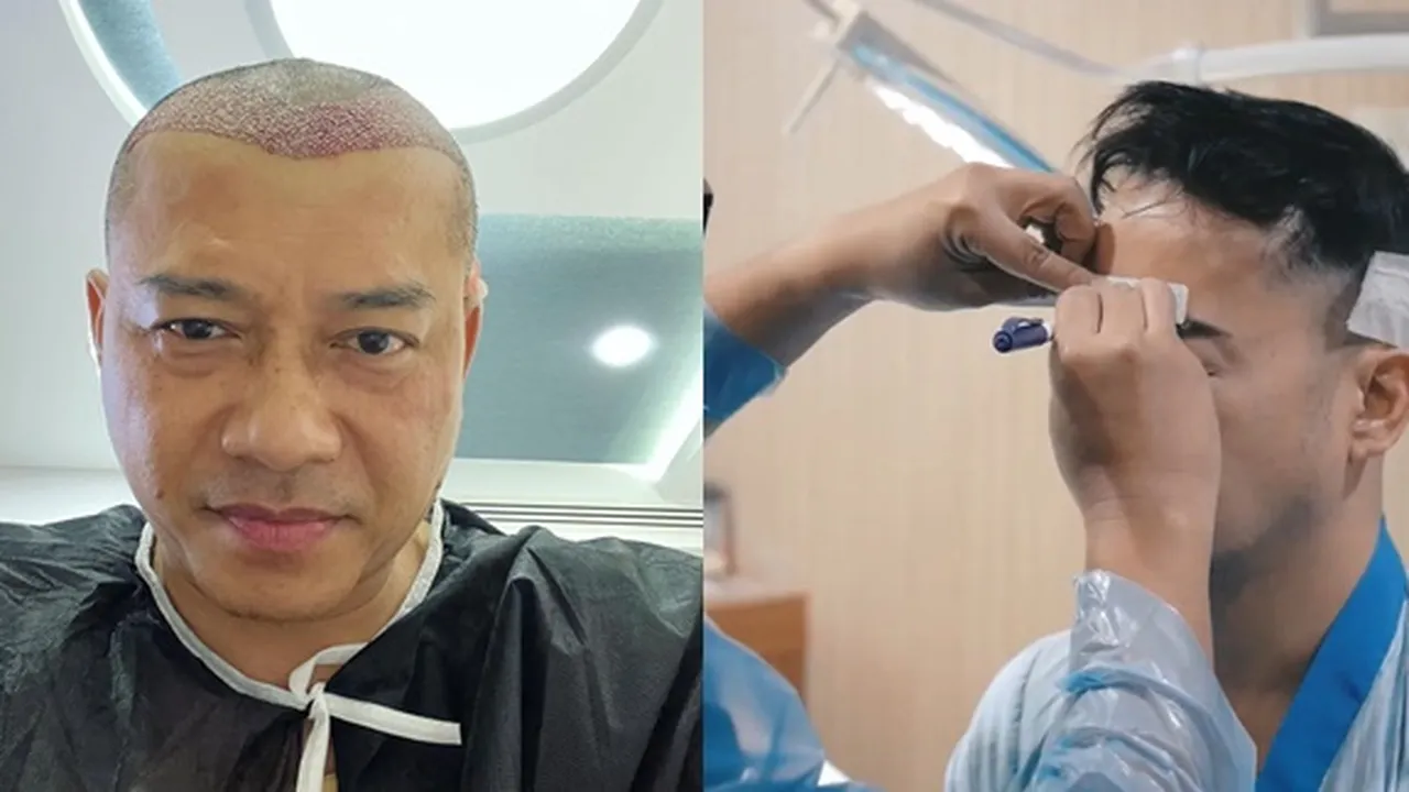 Bukan Cuma Anang Hermansyah, Sederet Seleb Ini Juga Pernah Jalani Transplantasi Rambut - Hasilnya Curi Perhatian