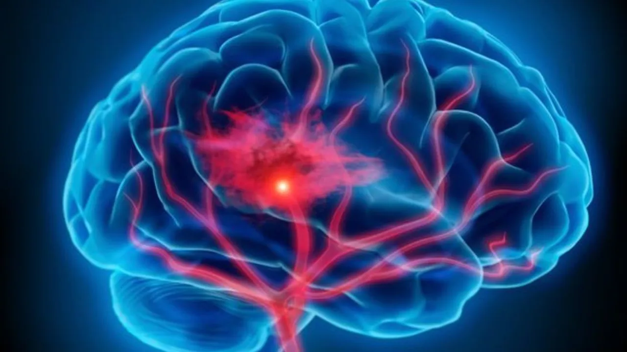 Cegah Stroke dan Tingkatkan Kesehatan Anda dengan Langkah Sederhana
