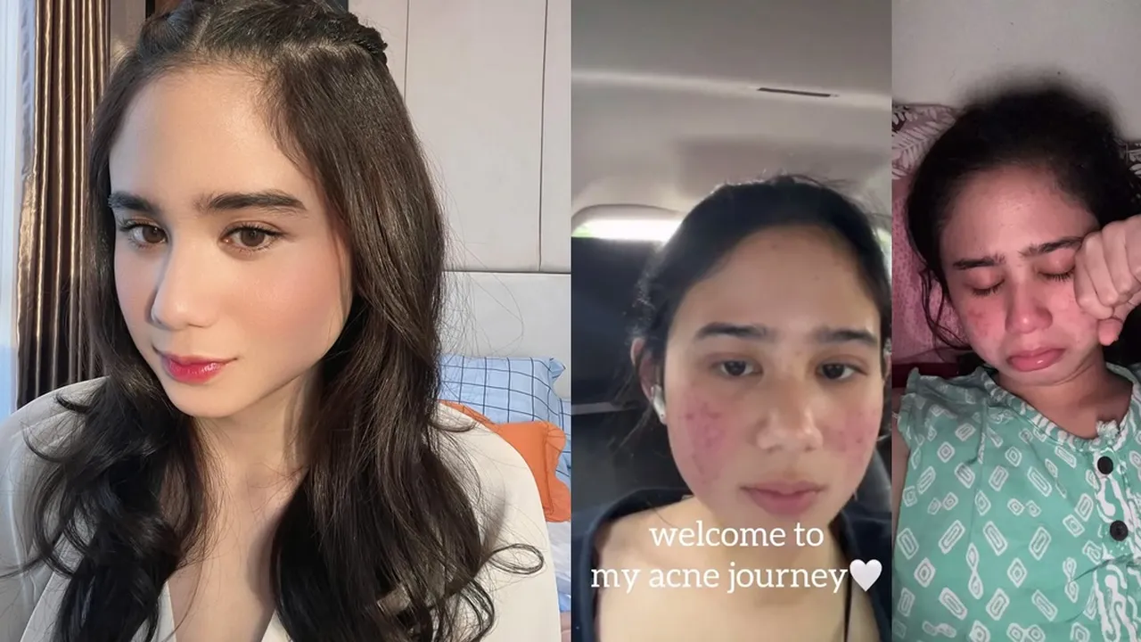 Cerita Tissa Biani Jadi Acne Fighter Selama 4 Tahun, Sempat Malu Bertemu Orang - Kini Berhasil Melewatinya