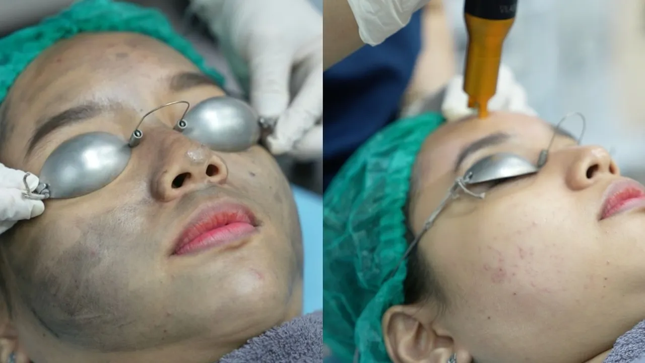 Hollywood Peel Laser: Rahasia Kulit Awet Muda Tanpa Waktu Pemulihan Lama