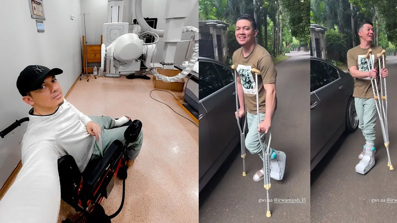 Kabar Terbaru Irwansyah Usai Alami Patah Tulang di Kaki, Dibantu Pakai Tongkat untuk Berjalan