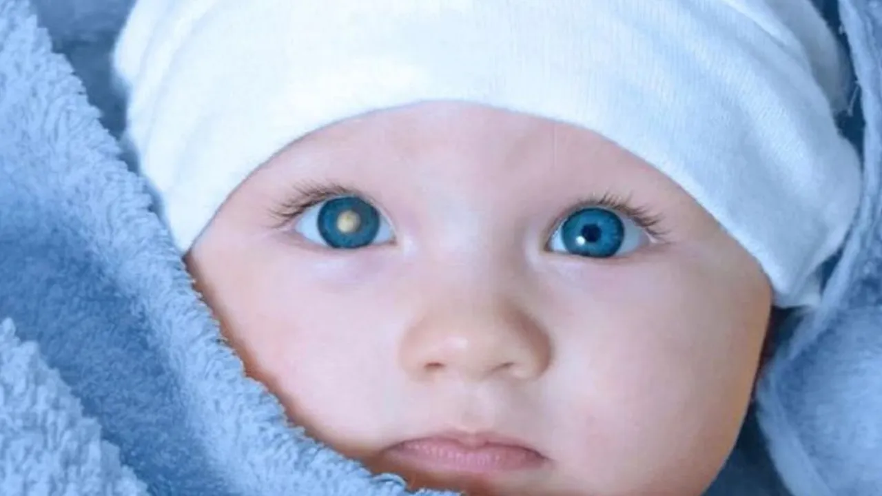 Kenali Gejala Retinoblastoma pada Anak Sejak Awal: Panduan Penting untuk Orang Tua