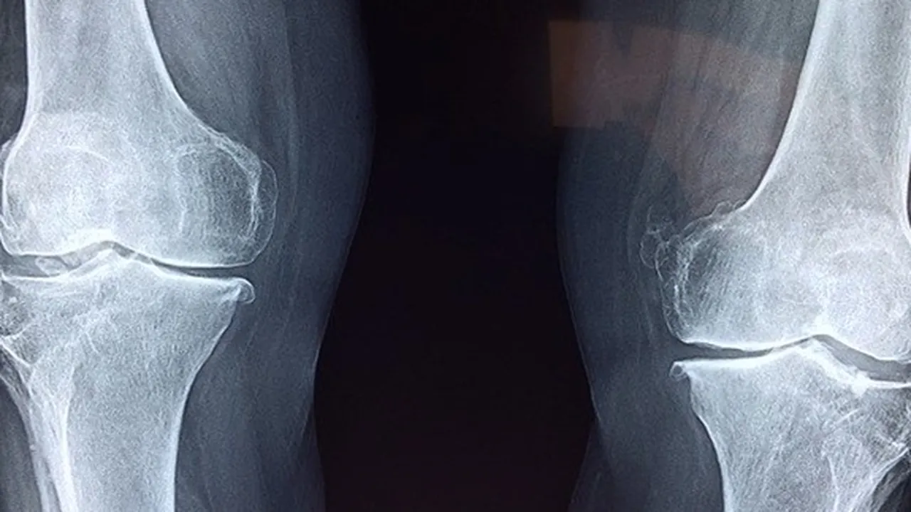 Kenali Sedini Mungkin! 7 Gejala Osteoporosis yang Perlu Kalian Tahu Agar Bisa Segera Diatasi