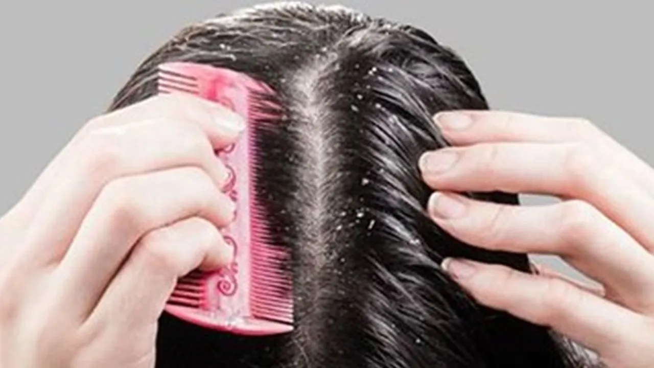 Perlu Diketahui Ini 5 Penyebab Ketombe, Salah Satunya Malas Menyisir Rambut