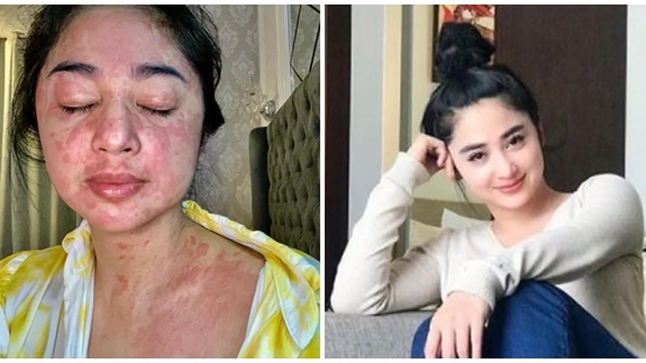 Sembuh Dari Covid, Dewi Perssik Jaga Kebersihan Hingga Mandi 5 Kali Sehari