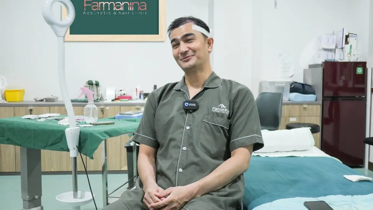 Shandy Sjariff Makin Percaya Diri Usai Transplantasi Rambut