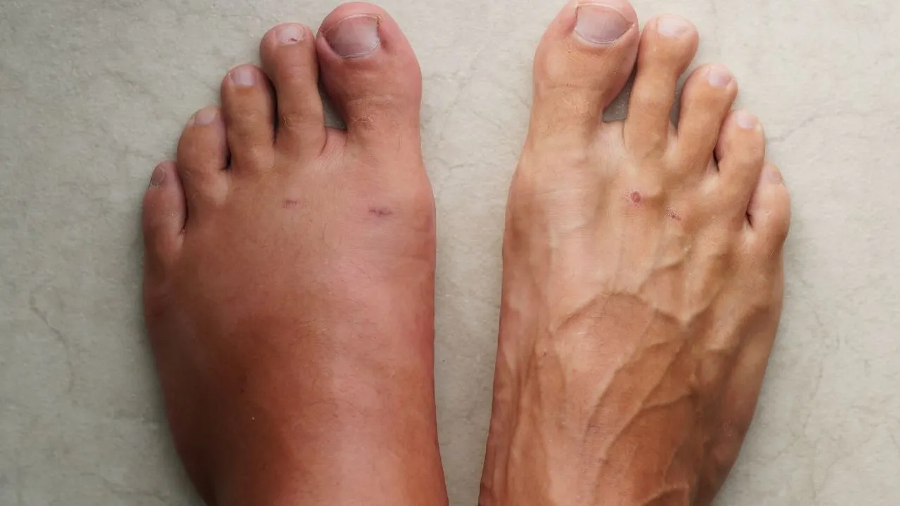 Solusi Ampuh untuk Kaki Bengkak: Temukan Penyebab, Pengobatan, dan Tips Pencegahannya!