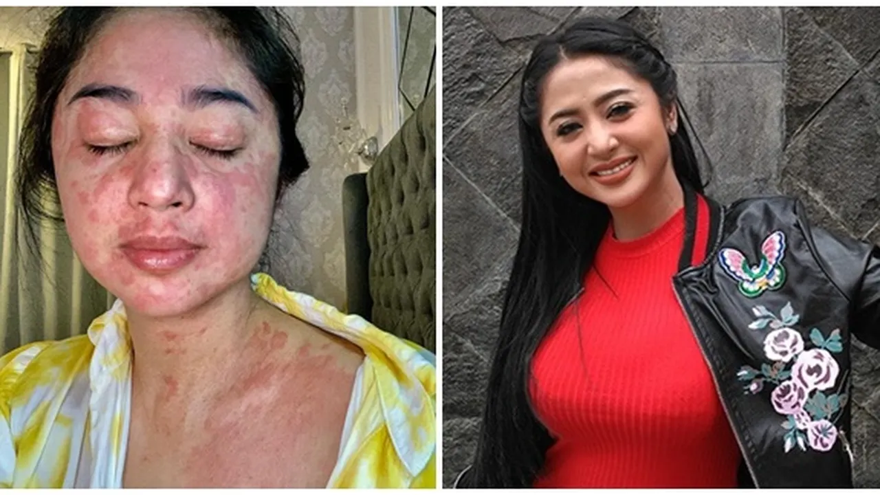 Terkait Alergi Parah yang Dialaminya Saat Terkena Covid, Dewi Perssik: 90% Langka