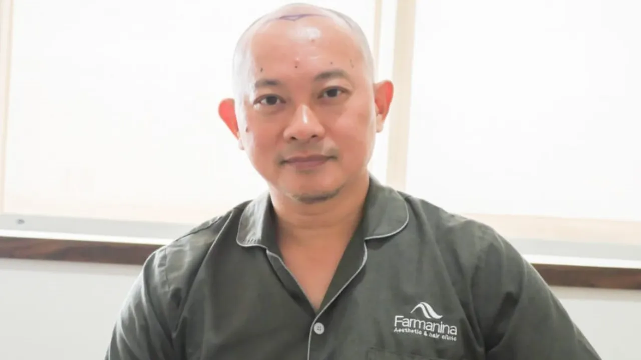Transplantasi Rambut, Verdi Solaiman Ingin Tampil Ekstrem Demi Peran Transplantasi Rambut, Verdi Solaiman Ingin Tampil Ekstrem Demi Peran