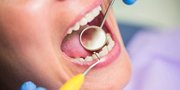 7 Penyebab Karang Gigi Membandel yang Umum Dialami dan Cara Mengatasinya