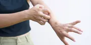 Kenali dan Atasi Ruam Kulit, Panduan Lengkap untuk Mengidentifikasi Ciri-Ciri Berbagai Jenis Ruam!