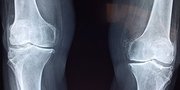Kenali Sedini Mungkin! 7 Gejala Osteoporosis yang Perlu Kalian Tahu Agar Bisa Segera Diatasi
