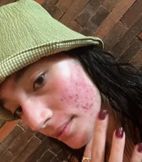 10 Potret Artis Tampil Percaya Diri Pamerkan Bare Face, Tetap Menawan Meski Wajah Berminyak - Jerawatan