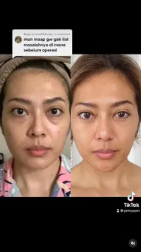 10 Potret Transformasi Yenny AFI yang Jujur Akui Oplas Hidung, Makin Cantik & Glow Up Banget