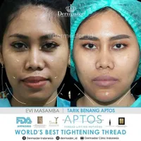 9 Potret Sebelum & Sesudah Para Penyanyi Ini Lakukan Tanam Benang, Pipi Makin Tirus - Pede Bertambah