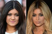 FOTO: Before-After Lip Injections, Bibir 9 Seleb Ini Makin Tebal