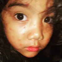 [FOTO] Dekapan Anji Buat Leticia Yang Kena Cacar, Setia Menemani