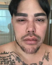 Ivan Gunawan Ungkap Soal Mata Bengkak Usai 'Berantem' dan Tonjok-Tonjokan, Sempat Alami Sesak Nafas 
