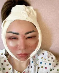 Potret Femmy Permatasari Setelah Oplas di Korea, Rela Wajah Bengkak dan 'Jelek' Dulu Pasca Lakukan 6 Prosedur Operasi