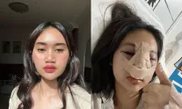 Sempat Lebam dan Bengkak di Wajah, Ini 8 Potret Permesta Dhyaz Anak Farida Nurhan Sebelum dan Sesudah Oplas Hidung di Thailand - Netizen Salfok Abis!