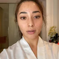 Ada Lesti Hingga Nikita Willy, 10 Artis Cantik Ini Tetap Percaya Diri Pamer Wajah Penuh Jerawat
