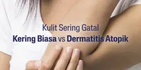 Kulit Eksim Butuh Pelembap yang Tepat, Ini Tips Memilihnya