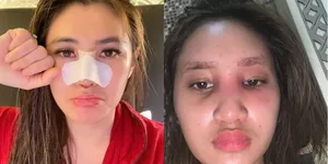 11 Artis Indonesia yang Jadi Korban Efek Samping Treatment Kecantikan, Ada yang Hidungnya Membusuk