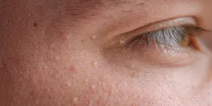 Penyebab Milia yang Dapat Dihindari, Kunci untuk Kulit Sehat dan Bersinar!