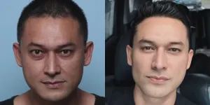 7 Potret Terbaru Indra Bruggman Usai Operasi di Bagian Mata, Awalnya Terlihat Cekung karena Hipertiroid - Pernah Difiller tapi Tak Membantu