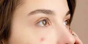 Cara Alami Menghilangkan Flek Hitam dan Bekas Jerawat di Wajah dengan Mudah