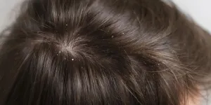 Cara Ampuh Mengatasi Ketombe Kering, Manfaat Rosemary dan Cuka Sari Apel