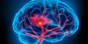 Cegah Stroke dan Tingkatkan Kesehatan Anda dengan Langkah Sederhana