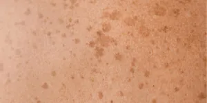 Fakta Mengejutkan, Apakah Kanker Kulit Bisa Menular Melalui Sentuhan? Simak Penjelasan Ahli!