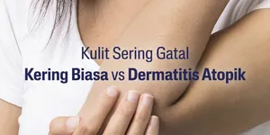 Kulit Eksim Butuh Pelembap yang Tepat, Ini Tips Memilihnya